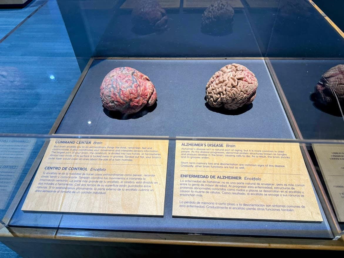 Alzheimer’s brain exhibit at The Tech Interactive showing the differences between a healthy and diseased brain.